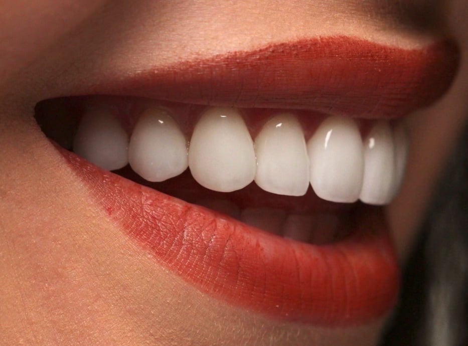 Custom All-on-X full-arch implant restoration by the Best Dental Lab for long-lasting function and aesthetics.