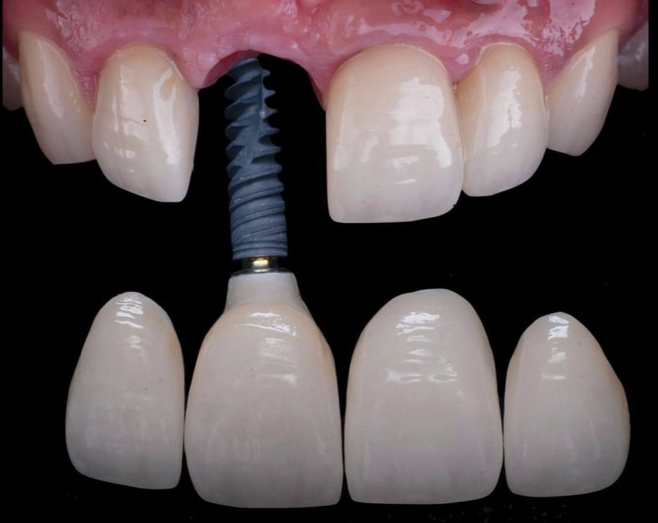 Expertly crafted dental implant restoration from the Best Dental Lab, ensuring secure and natural-looking tooth replacement.